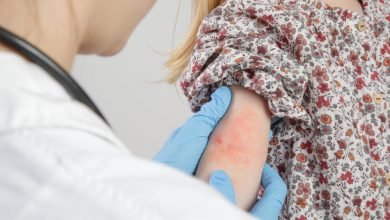 حساسية الحليب واللحمة