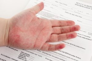 الأطعمة التفاعلية عبر اللاتكس والحساسية منه 3 الأطعمة التفاعلية عبر اللاتكس