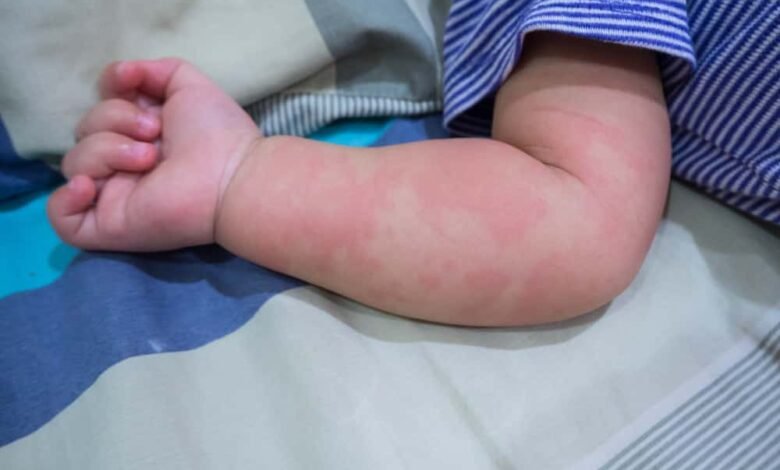 أعراض حساسية الجلوتين عند الأطفال