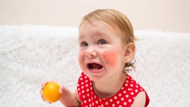 حساسية الحمضيات