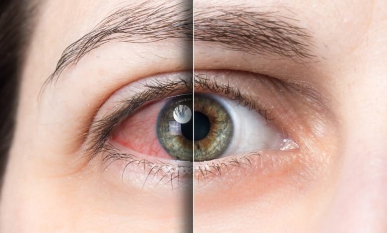 هل حساسية العين تؤثر على النظر؟