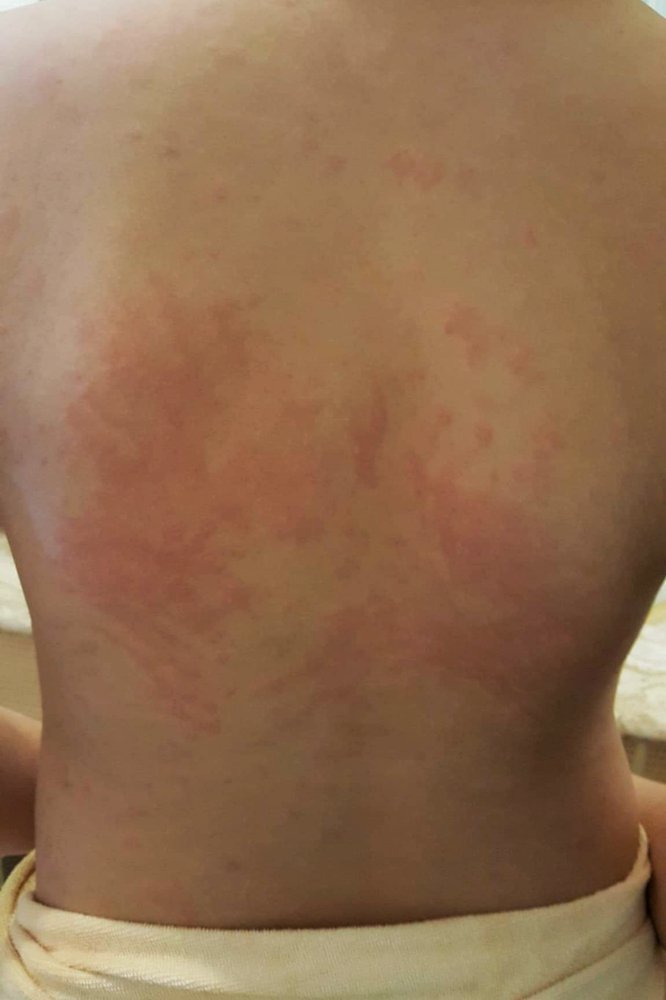 تحسس البنسلين