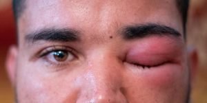 حساسية ركوب الخيل