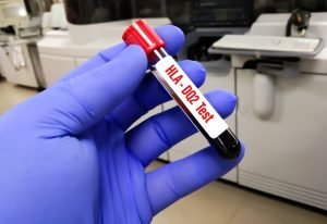 ماذا تعرف عن تحليل مرض السيلياك وقراءة النتائج 2 تحليل مرض السيلياك