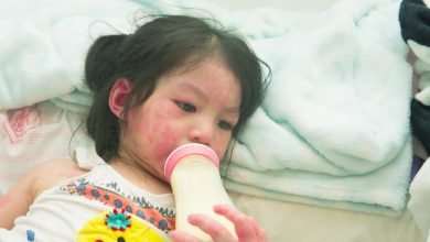 حساسية الحليب البقري