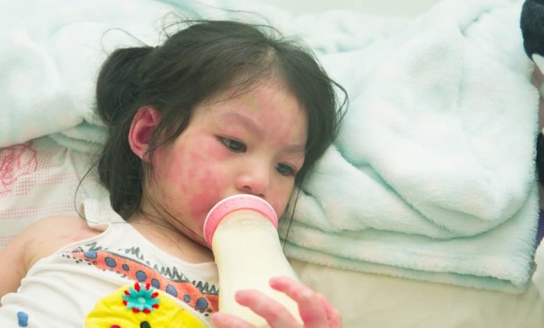 حساسية الحليب البقري