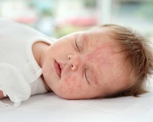 حساسية الحليب للرضع