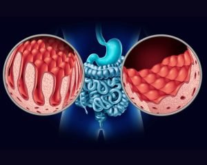 أعراض مرض سيلياك