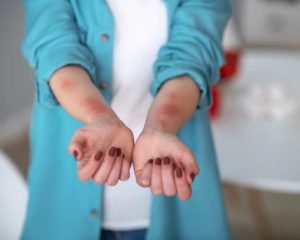 ما هو الفرق بين حساسية الحليب وحساسية اللاكتوز؟ 2 الفرق بين حساسية الحليب وحساسية اللاكتوز