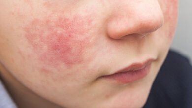 الحساسية من البرد