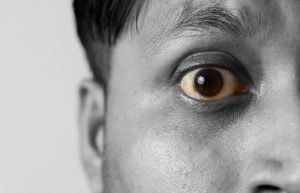 الرابط بين السيلياك والعيون قد يكون مؤشرا خطيرا عليك الحذر منه 2 السيلياك والعيون